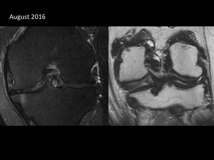 Figure 5 for case pigmented villonodular synovitis ( RID3641 )